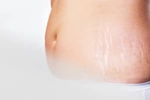 Stretch Marks Removal Treatment