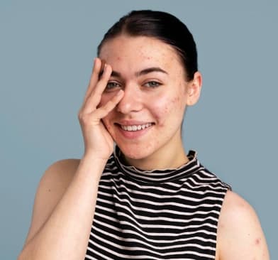 Acne: Causes and Effective Treatment Options