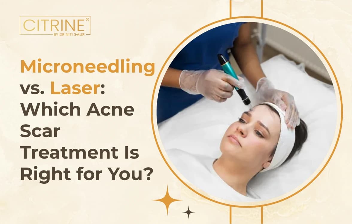 Microneedling vs. Laser: Which Acne Scar Treatment Is Right for You?