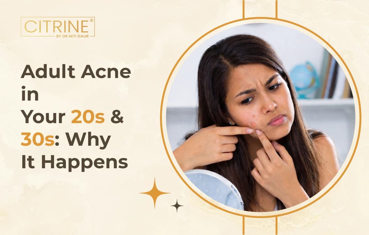 Adult Acne in Your 20s & 30s: Why It Happens