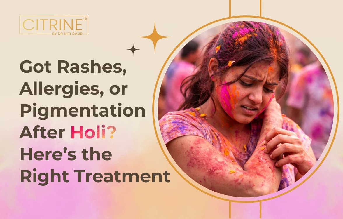Got Rashes, Allergies, or Pigmentation After Holi? Here’s the Right Treatment