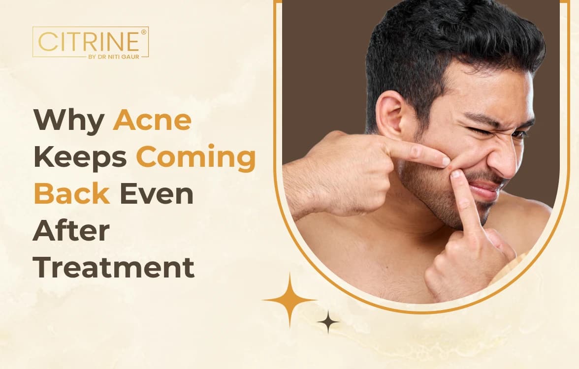 Why Acne Keeps Coming Back Even After Treatment?