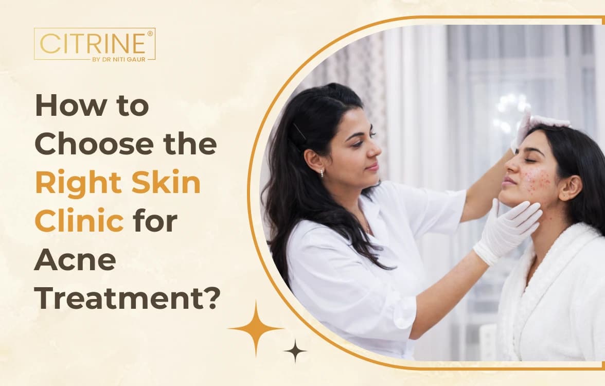 How to Choose the Right Skin Clinic for Acne Treatment?