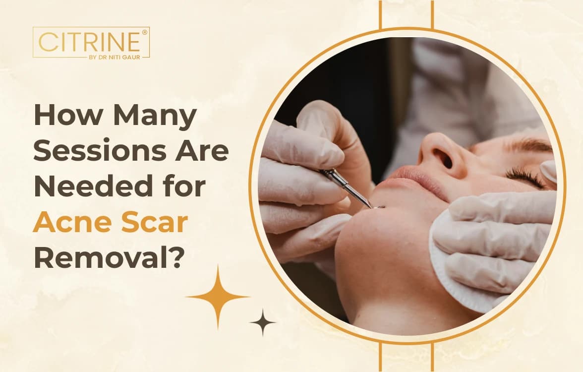 How Many Sessions Are Needed for Acne Scar Removal?