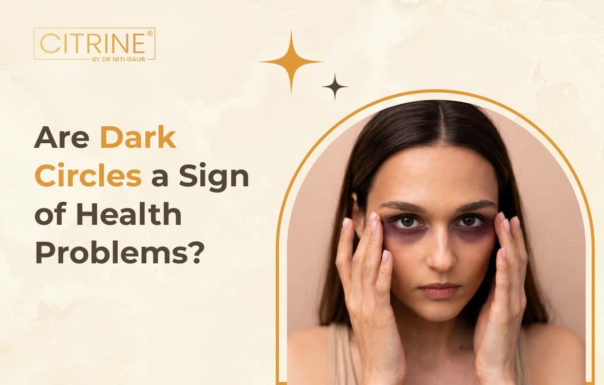 Are Dark Circles a Sign of Health Problems?