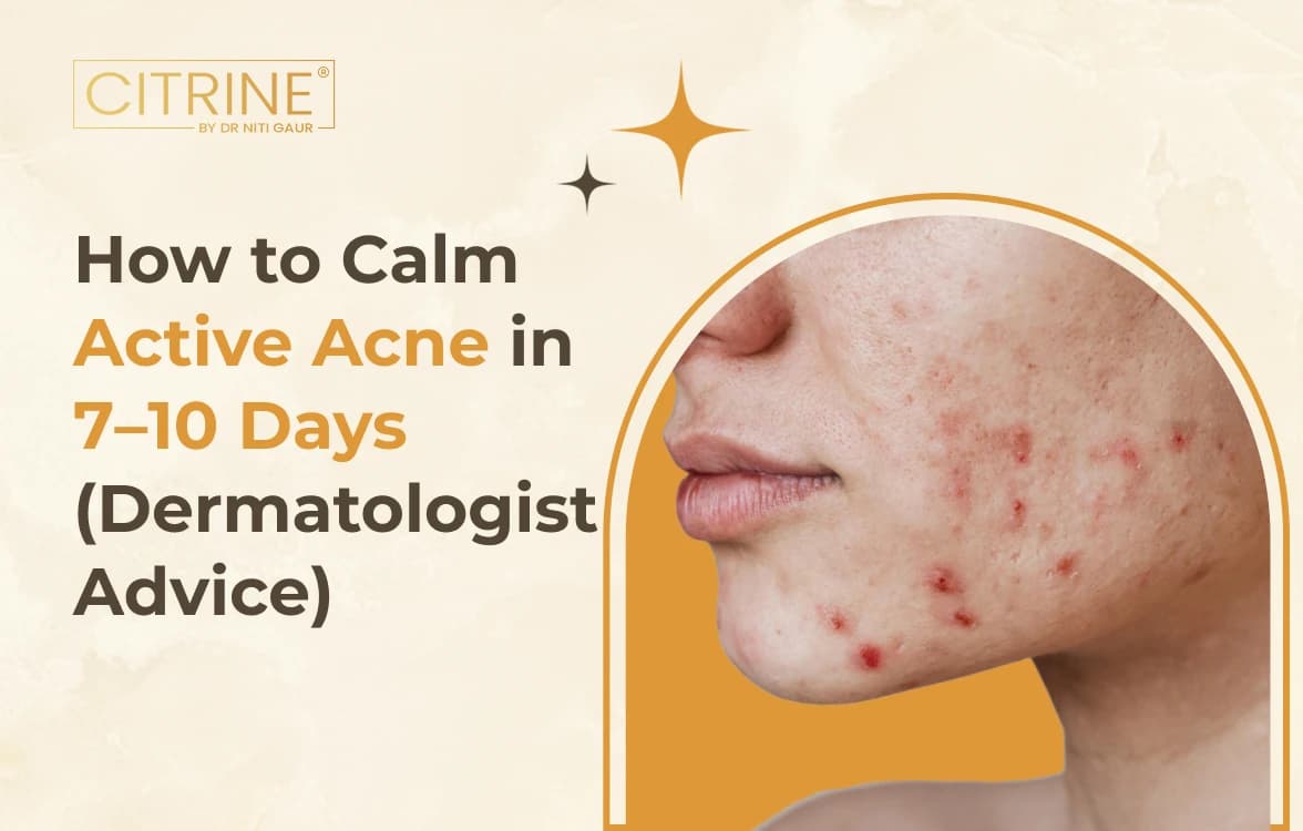 How to Calm Active Acne in 7–10 Days (Dermatologist Advice)