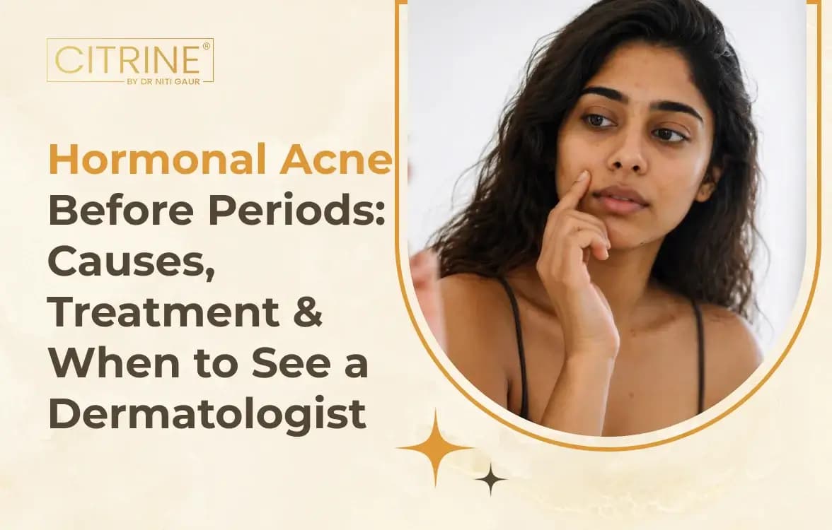 Hormonal Acne Before Periods: Causes, Treatment & When to See a Dermatologist