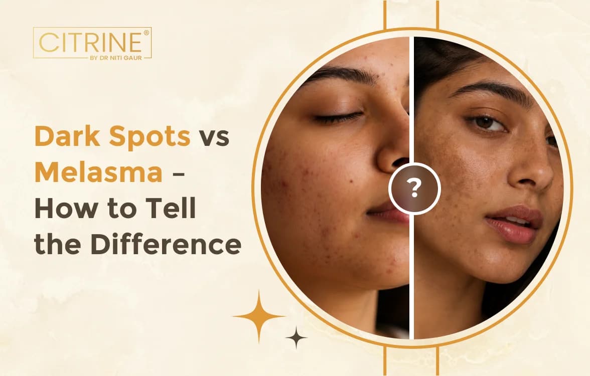 Dark Spots vs Melasma – How to Tell the Difference