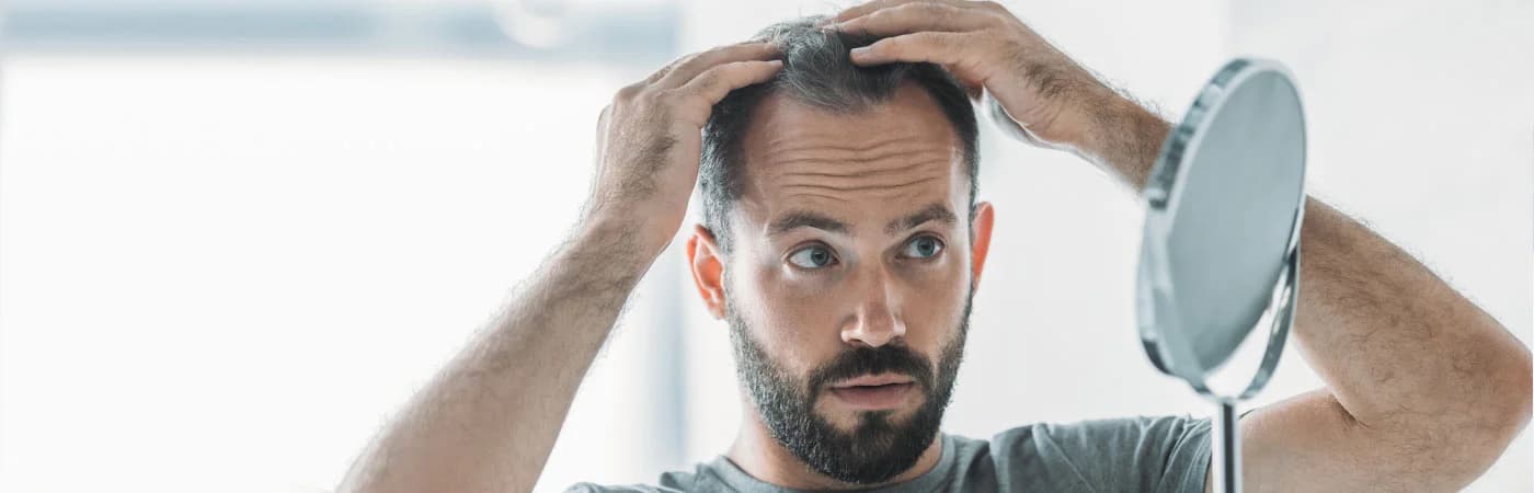 Alopecia Areata