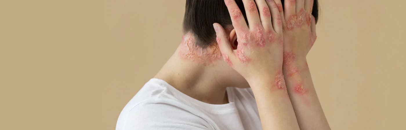 Psoriasis