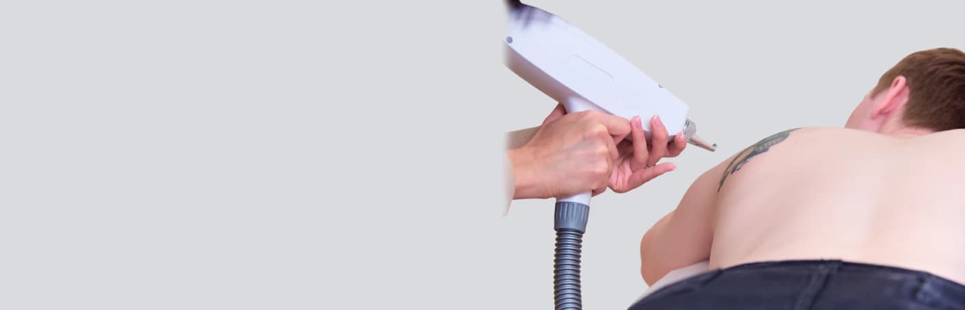 Laser Tattoo Removal