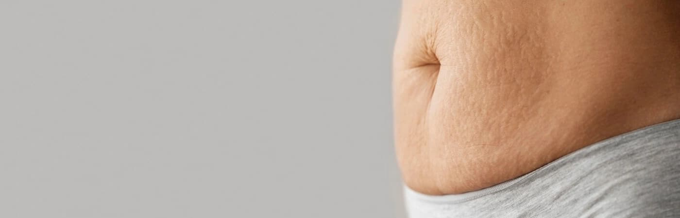 Stretch Marks Treatment in Delhi