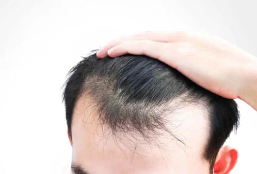 FUE Hair Transplant in Gurgaon