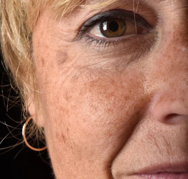 Age spots and pigmentation