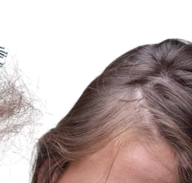 Telogen Eﬄuvium
