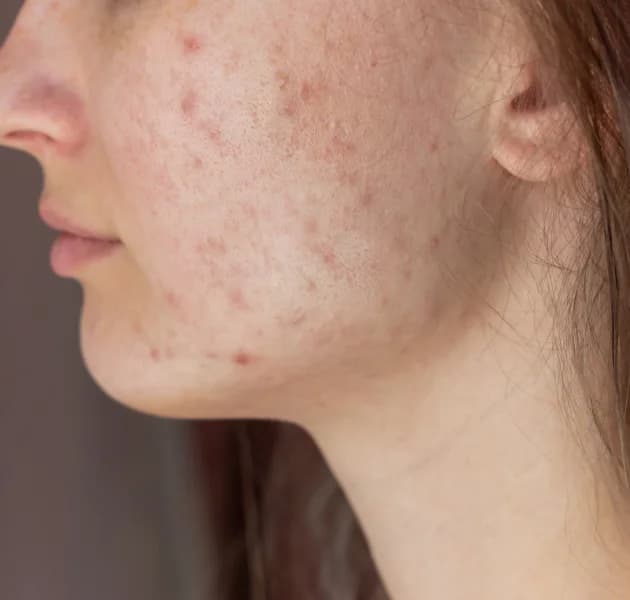 Post-inflammatory Hyperpigmentation (PIH)
