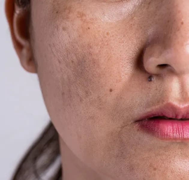 Lichen Planus Pigmentosus (LPP)