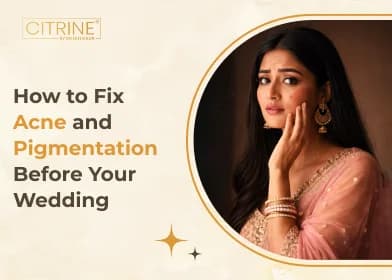 How to Fix Acne and Pigmentation Before Your Wedding