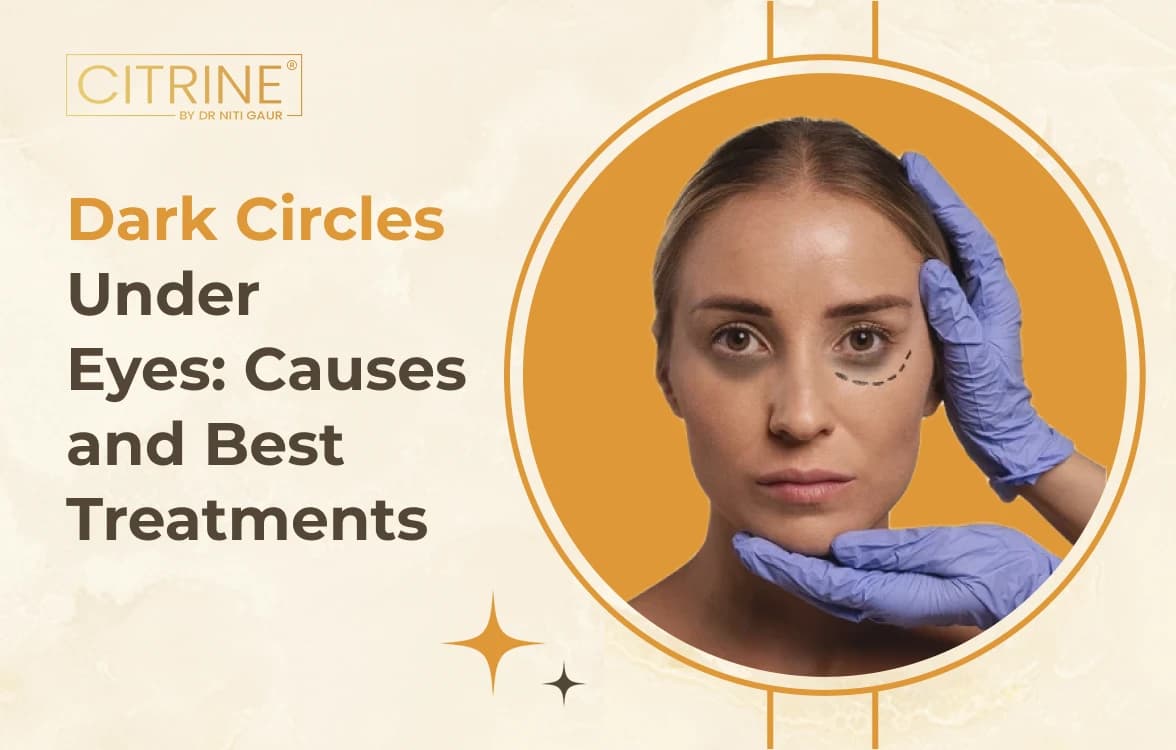 Dark Circles Under Eyes: Causes and Best Treatments