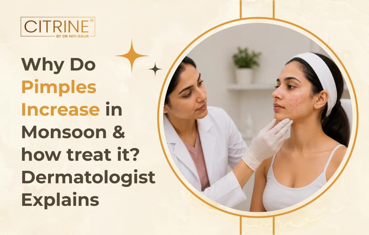 Why Do Pimples Increase in Monsoon & How to Treat It? Dermatologist Explains