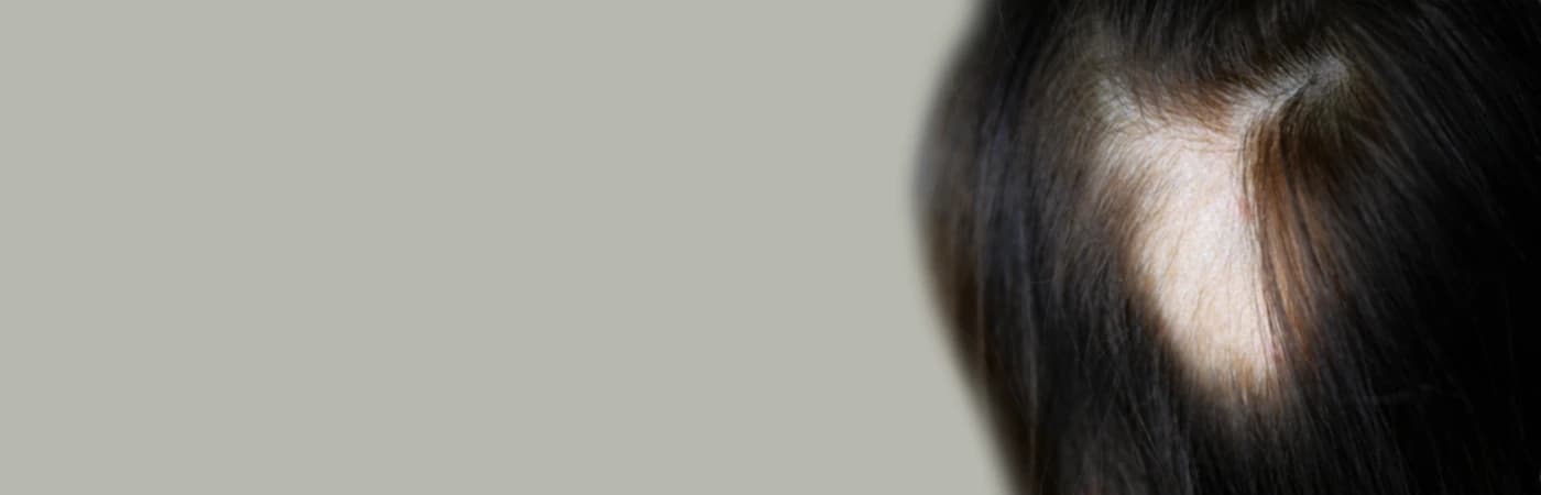 Androgenetic Alopecia