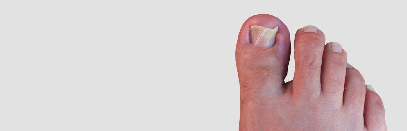 Ingrown Toenails