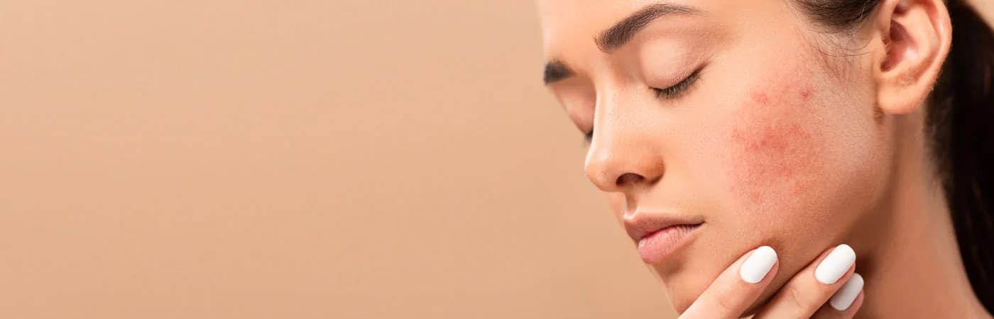 Acne Treatment in Delhi