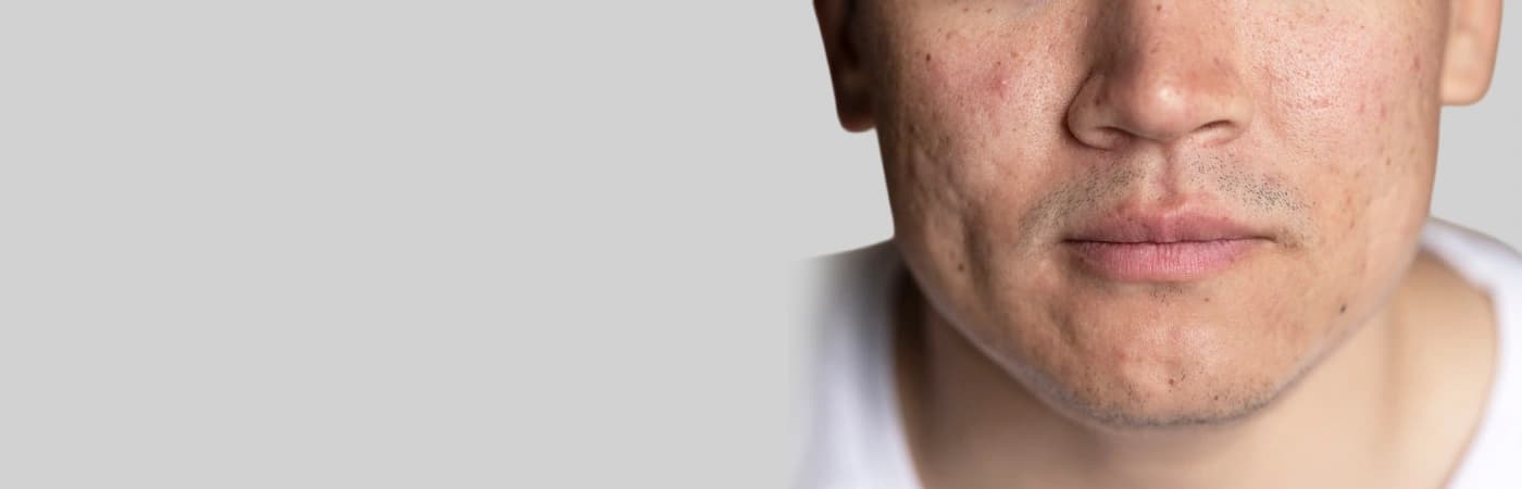 Open Pores Treatment in Delhi