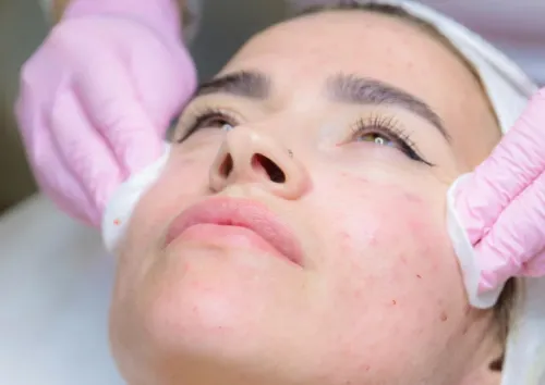 Acne Facials