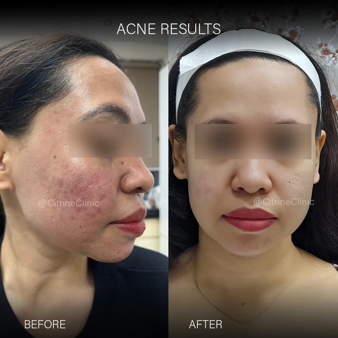 Before & After Acne Treatment