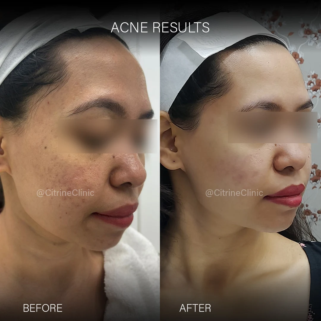 Before & After Acne Scar Treatment