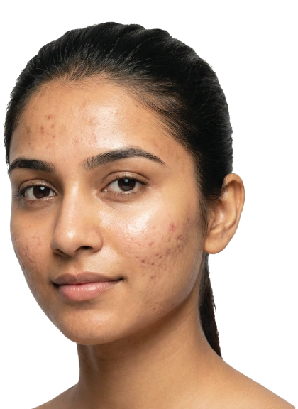 Acne & Acne Scars Treatment in Gurgaon