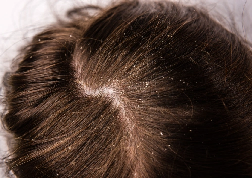 Dandruff & Scalp Care