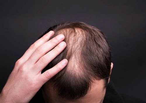 Anti-Hair Thinning Solutions