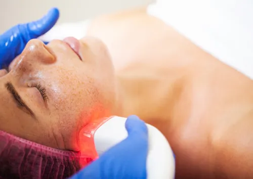 Melasma Laser Treatment
