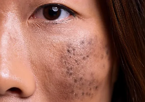 Hyperpigmentation Treatment
