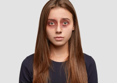 Dark Circles