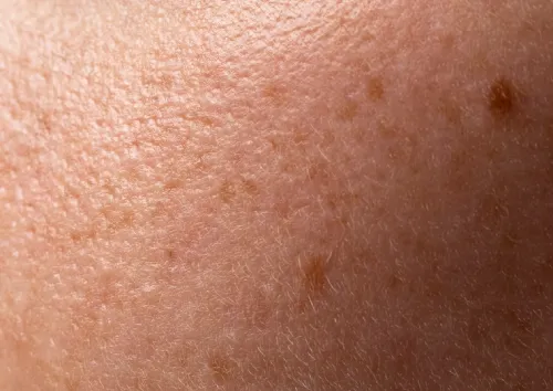 Treatment for Melasma