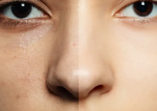 Pigmentation Removal Treatment