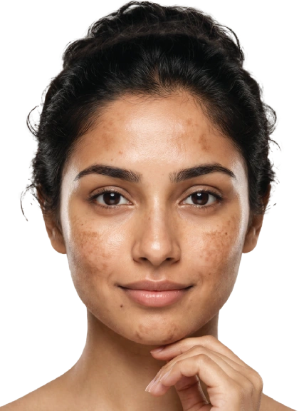 Acne & Acne Scars Treatment in Gurgaon