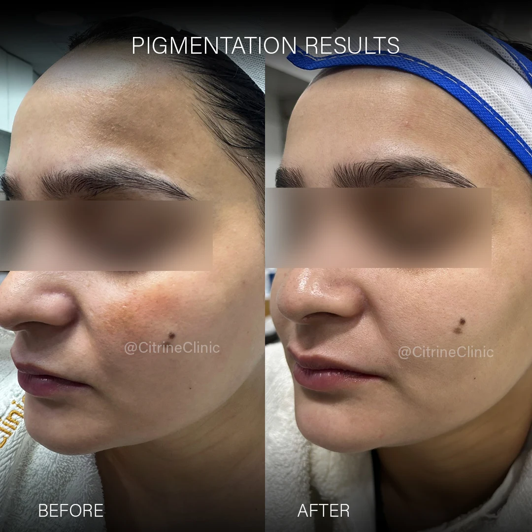 pigmentation before & after