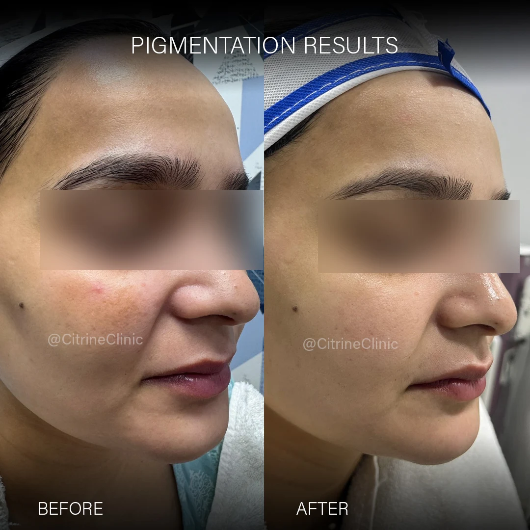 pigmentation before & after
